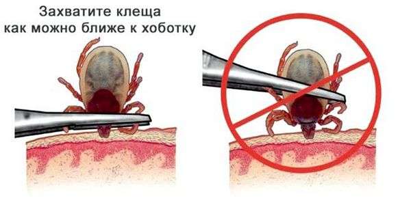 Достать клеща с помощью масла. Как правильно вытащить присосавшегося клеща у человека