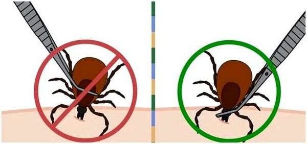 Как правильно удалить клеща из тела человека в домашних условиях. Как снимать клеща с человека: способы и особенности удаления