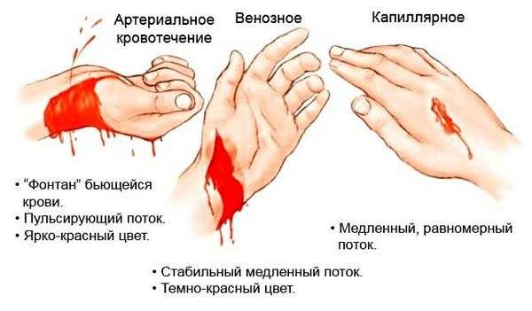 Первая помощь при артериальном кровотечении правила наложения жгута и закрутки. Первая помощь при артериальном кровотечении